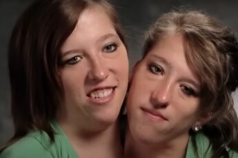 Conjoined twins Abby and Brittany Hensel